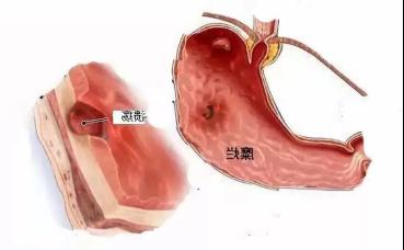 貴陽微創胃腸專科醫院:被忽視的胃問題——消化性潰瘍 貴陽微創胃腸專科醫院:被忽視的胃問題——消化性潰瘍