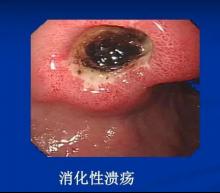 貴陽微創胃腸專科醫院:被忽視的胃問題——消化性潰瘍 貴陽微創胃腸專科醫院:被忽視的胃問題——消化性潰瘍