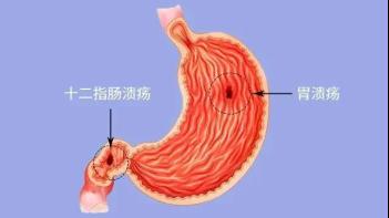 貴陽微創胃腸專科醫院:被忽視的胃問題——消化性潰瘍 貴陽微創胃腸專科醫院:被忽視的胃問題——消化性潰瘍