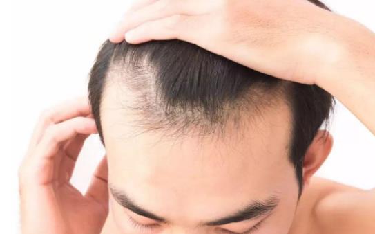 男人脫發怎么辦?男人脫發是什么原因引起的