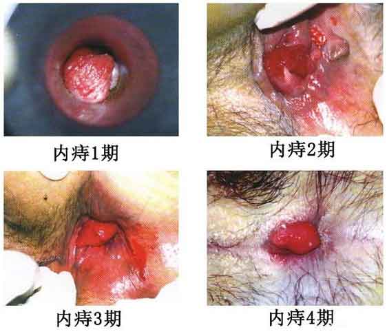 女性痔瘡真人實拍圖片 網上曝光的7個小偏方有效治痔瘡 女性痔瘡真人實拍圖片 網上曝光的7個小偏方有效治痔瘡