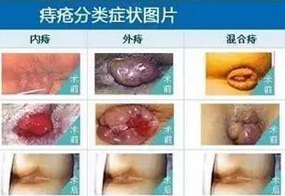 女性痔瘡真人實拍圖片 網上曝光的7個小偏方有效治痔瘡 女性痔瘡真人實拍圖片 網上曝光的7個小偏方有效治痔瘡