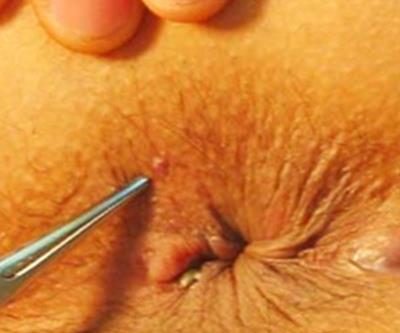 女性痔瘡的圖片,痔瘡的臨床表現、檢查、診斷及手術治療