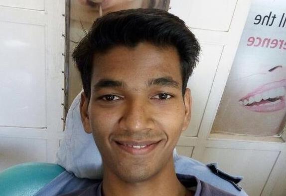 18歲少年拔出世界上最長的牙齒4.jpg