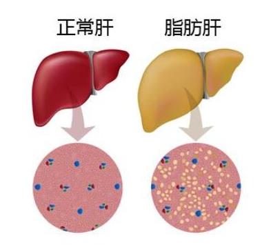 十大男性高發(fā)疾病排行榜,肺癌和吸煙有關(guān)、肝癌愛(ài)找上男人