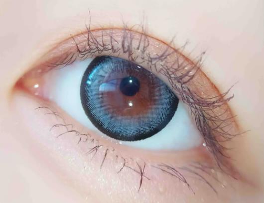 割雙眼皮后多久恢復自然?雙眼皮疤痕多久消失 割雙眼皮后多久恢復自然?雙眼皮疤痕多久消失