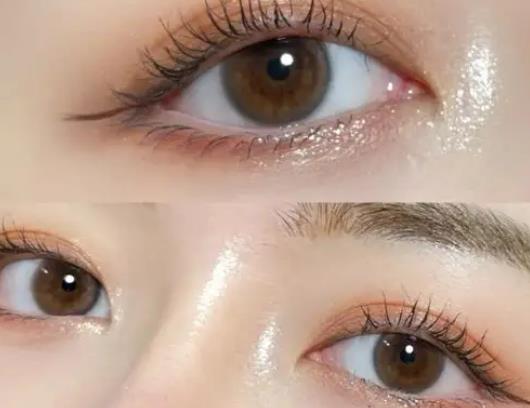 雙眼皮緊繃感是粘連引起的嗎?雙眼皮寬了會慢慢變窄嗎 雙眼皮緊繃感是粘連引起的嗎?雙眼皮寬了會慢慢變窄嗎