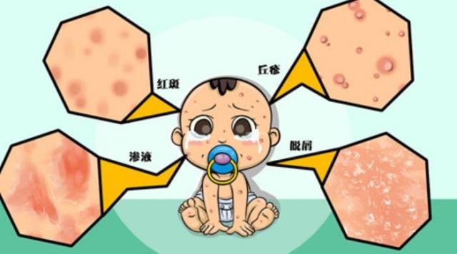 新生兒濕疹發病原因及癥狀 新生兒濕疹怎么辦 新生兒濕疹發病原因及癥狀 新生兒濕疹怎么辦