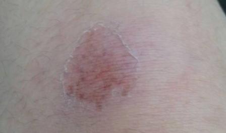 摔傷用什么藥?摔傷腫了怎么有效處理 摔傷用什么藥?摔傷腫了怎么有效處理