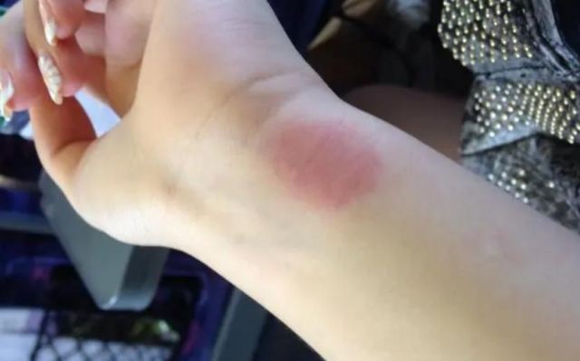 芒果過敏原因是什么呢 如何判斷是不是芒果過敏 芒果過敏原因是什么呢 如何判斷是不是芒果過敏