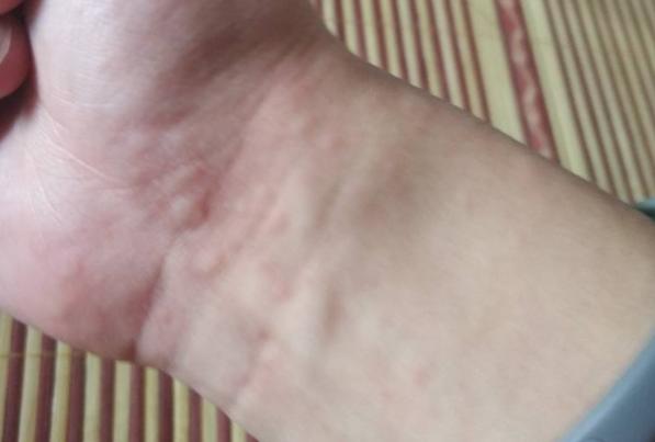 芒果過敏會死人嗎 芒果輕度過敏的癥狀 芒果過敏會死人嗎 芒果輕度過敏的癥狀