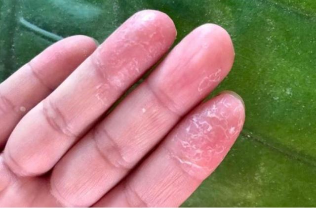 手癬初期癥狀是什么 手癬初期如何治療 手癬初期癥狀是什么 手癬初期如何治療
