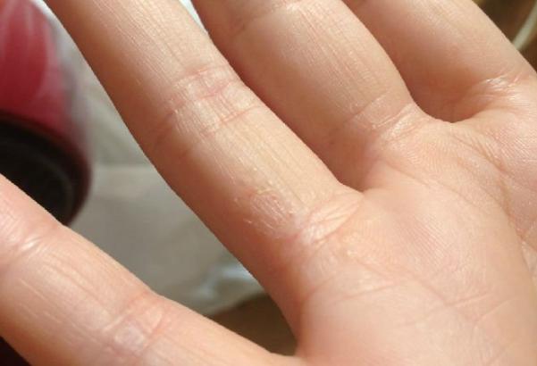 有能根治水泡型的藥膏?中醫可以水泡型手癬嗎? 有能根治水泡型的藥膏?中醫可以水泡型手癬嗎?