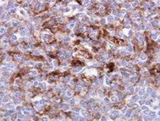 世界十大治不愈的病,慢性疲勞綜合癥、自身免疫失調都是慢性難治療 世界十大治不愈的病,慢性疲勞綜合癥、自身免疫失調都是慢性難治療