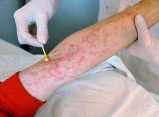 世界十大治不愈的病,慢性疲勞綜合癥、自身免疫失調都是慢性難治療 世界十大治不愈的病,慢性疲勞綜合癥、自身免疫失調都是慢性難治療