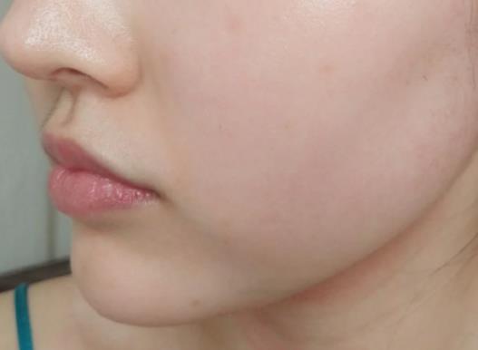 服用阿維A真的要兩年以后才能要孩子嗎?吃異維a酸軟膠囊會胎停嗎 服用阿維A真的要兩年以后才能要孩子嗎?吃異維a酸軟膠囊會胎停嗎