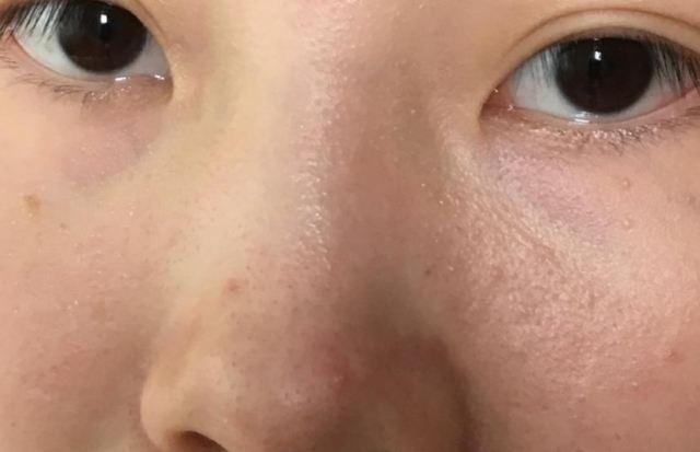 臉上總出油是怎么回事?臉愛出油的常見兩個(gè)因素 臉上總出油是怎么回事?臉愛出油的常見兩個(gè)因素