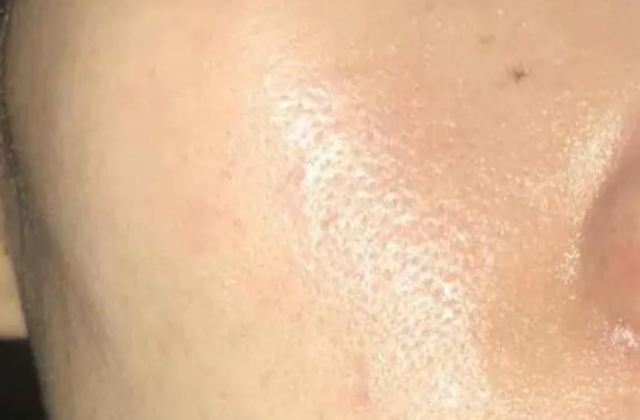 臉上一直出油怎么辦 臉上冒痘跟出油有關系嗎 臉上一直出油怎么辦 臉上冒痘跟出油有關系嗎