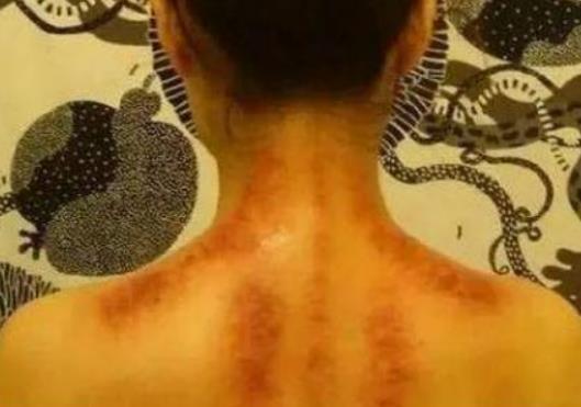 刮痧是去濕氣還是寒氣?刮痧能去除體內(nèi)濕氣嗎 刮痧是去濕氣還是寒氣?刮痧能去除體內(nèi)濕氣嗎