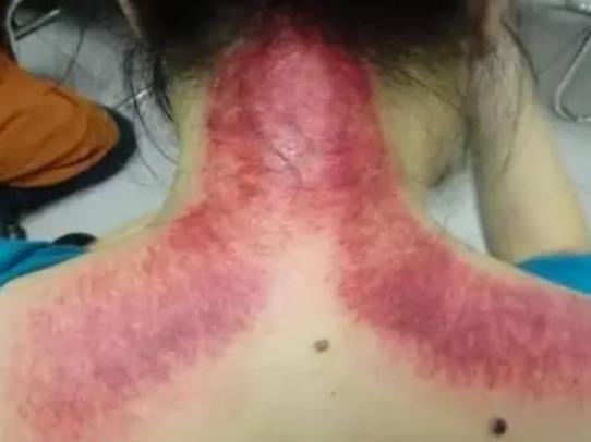 刮痧時癢是在排毒嗎?刮痧黑紫色很嚴重嗎 刮痧時癢是在排毒嗎?刮痧黑紫色很嚴重嗎